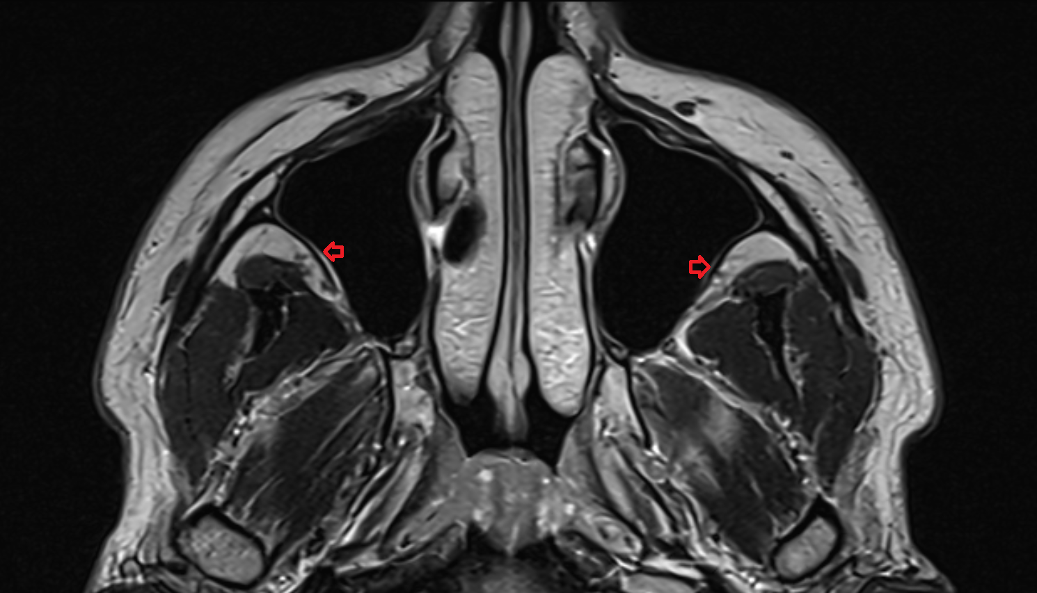 MRI Lateral wall of maxillary sinus  anatomy image -img-00000-00000