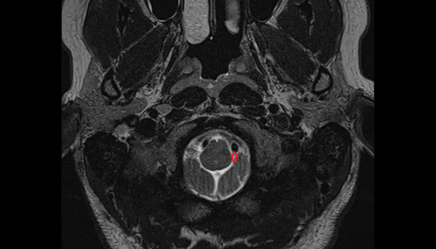 MRI Left vertebral artery axial anatomy image -img-00000-00000