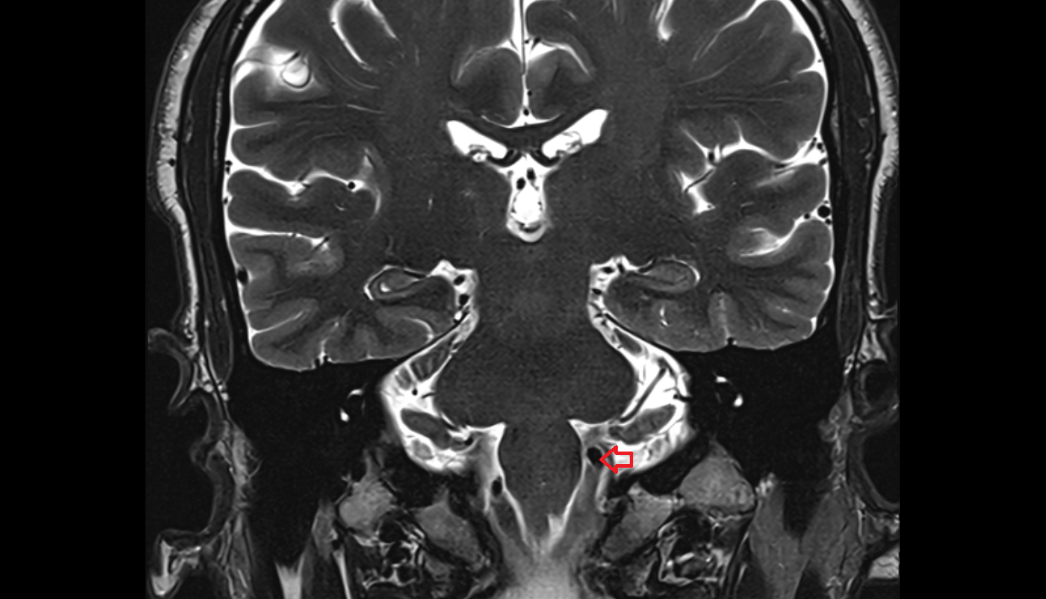 MRI Left vertebral artery coronal anatomy image -img-00000-00000