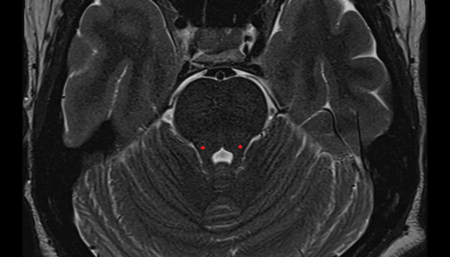 MRI Locus ceruleus axial anatomy image -img-00000-00000