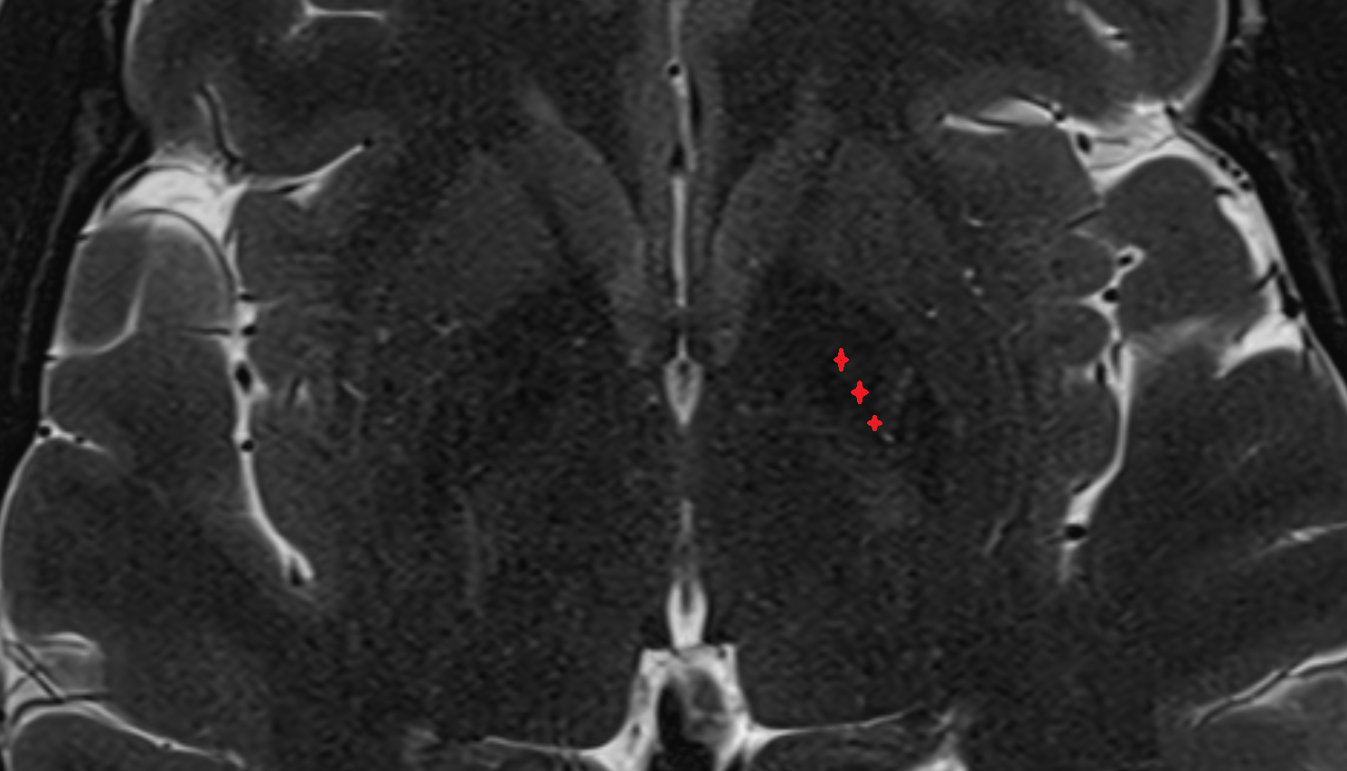 MRI Medial (internal) pallidum axial anatomy image -img-00000-00000