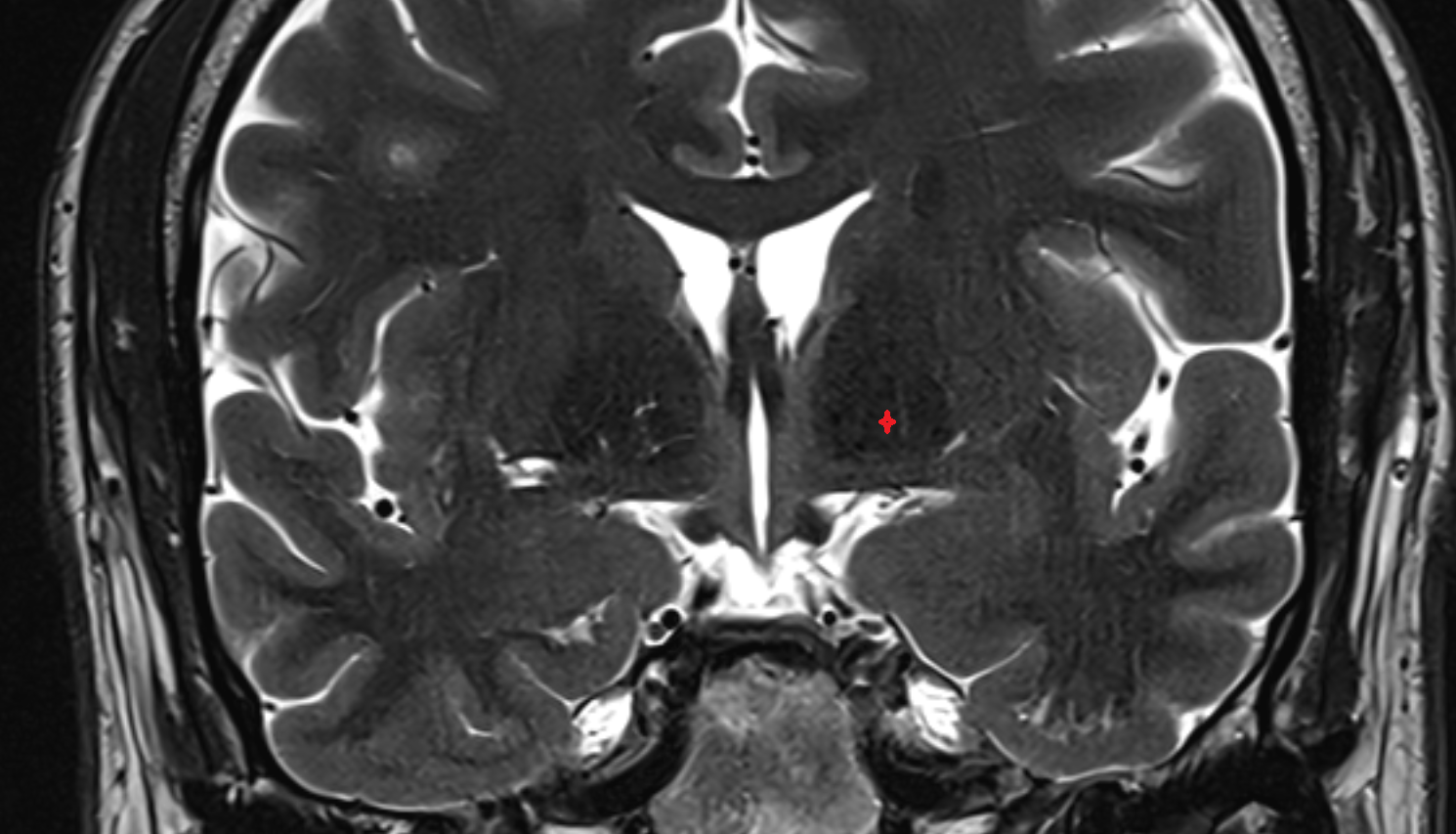MRI Medial (internal) pallidum axial anatomy image -img-00000-00000_00001