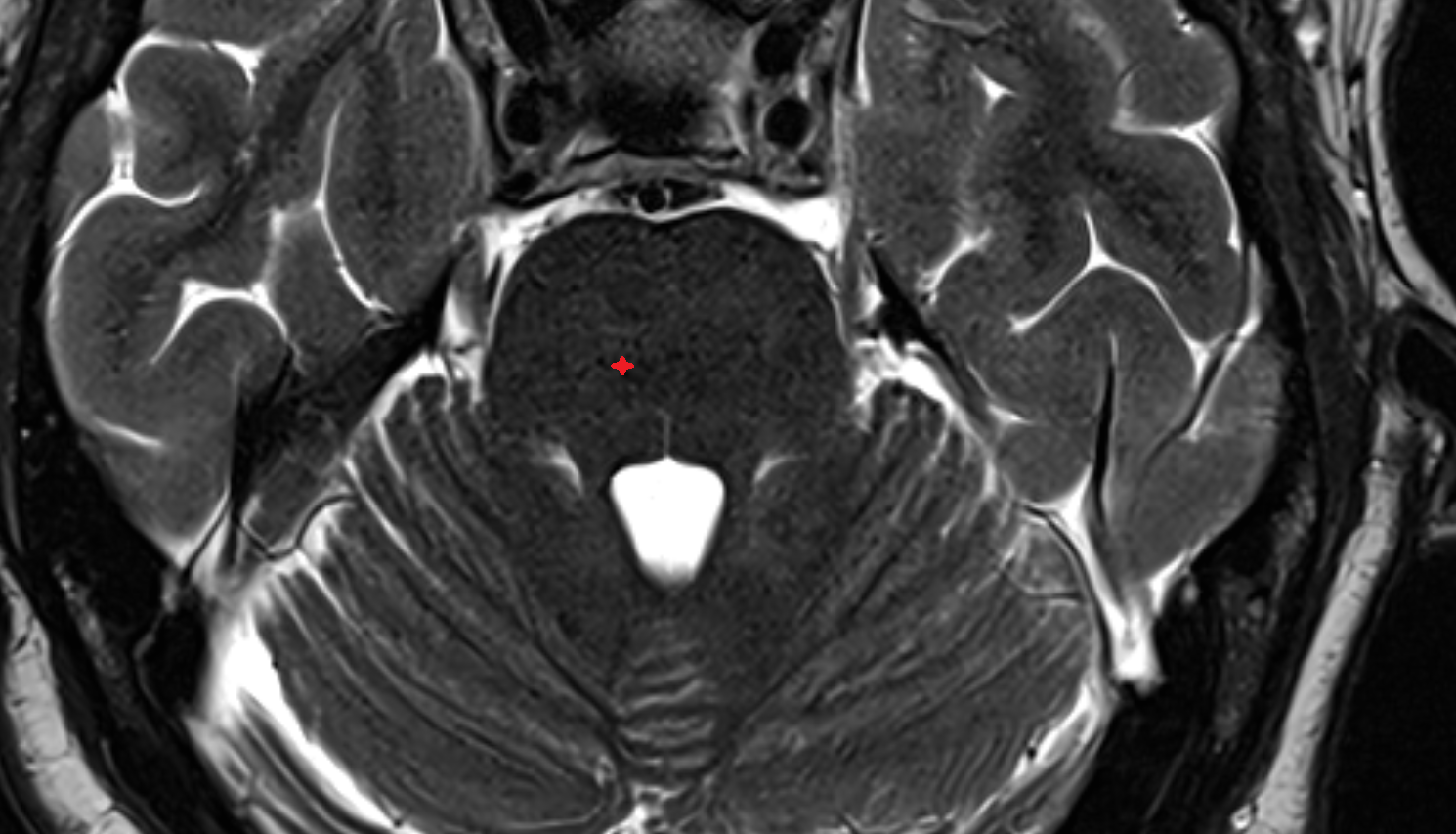 MRI Medial lemniscus axial anatomy image -img-00000-00000