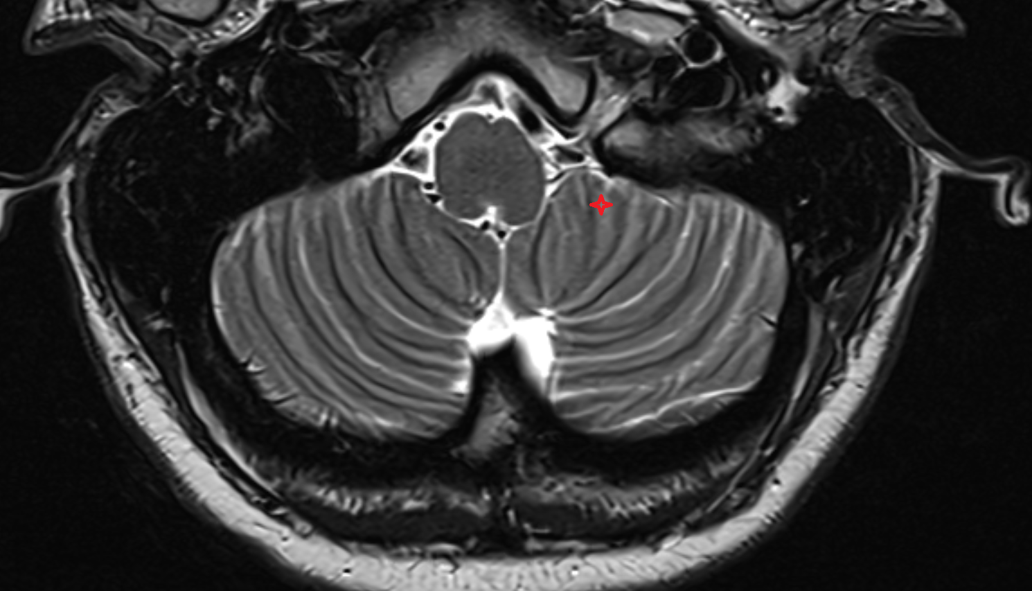 MRI Medial part of biventeral lobule axial anatomy image -img-00000-00000