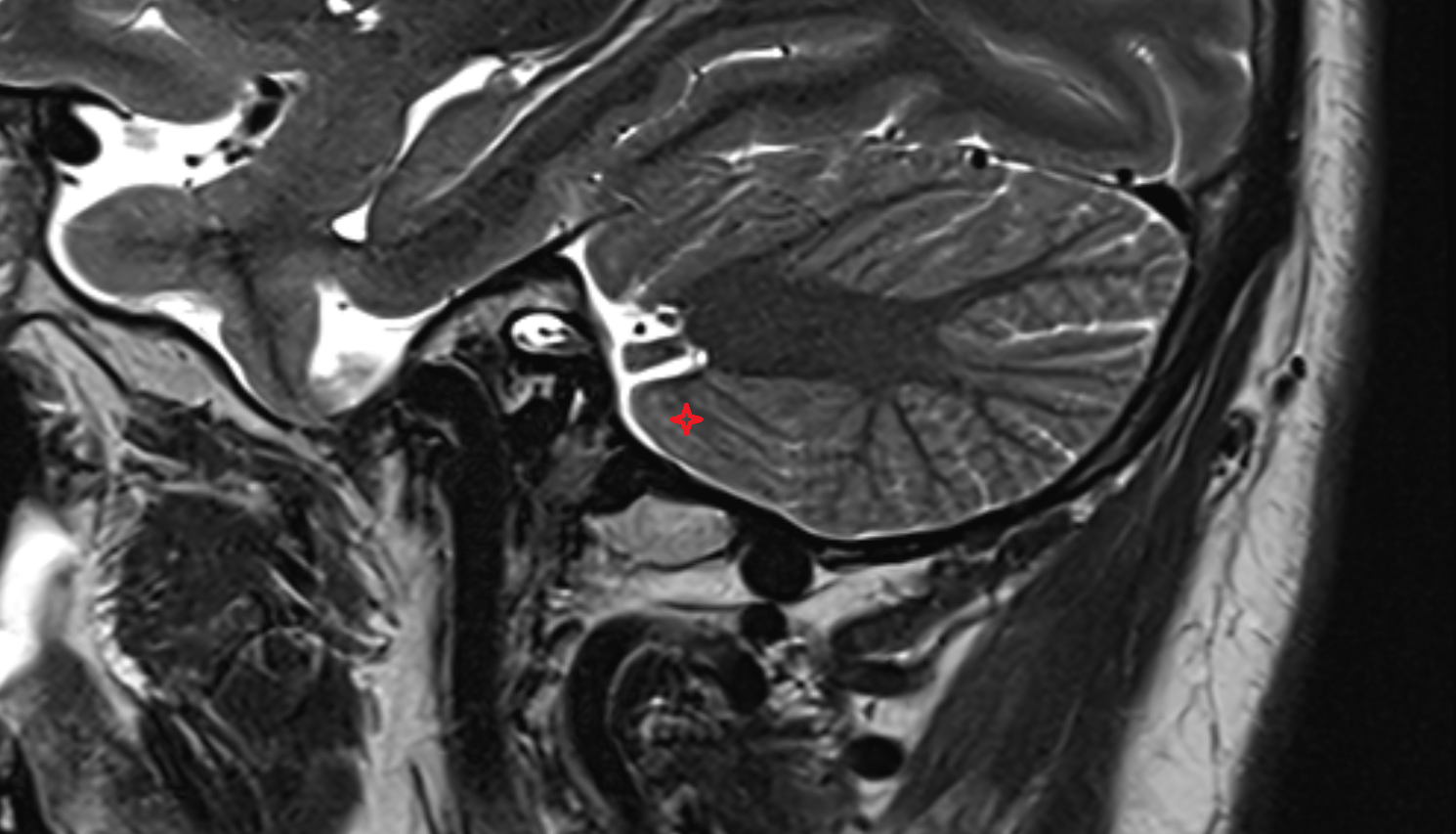 MRI Medial part of biventeral lobule sag anatomy image -img-00000-00000