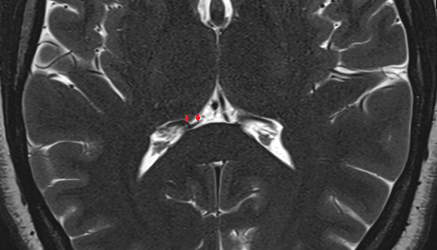 MRI Medial vein of lateral ventricle anatomy image -img-00000-00000
