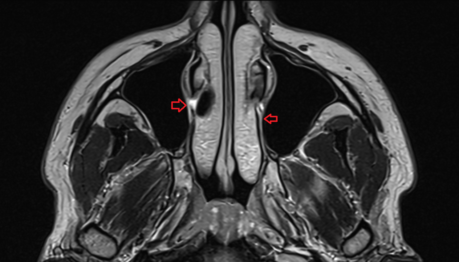 MRI Medial wall of maxillary sinus  anatomy image -img-00000-00000