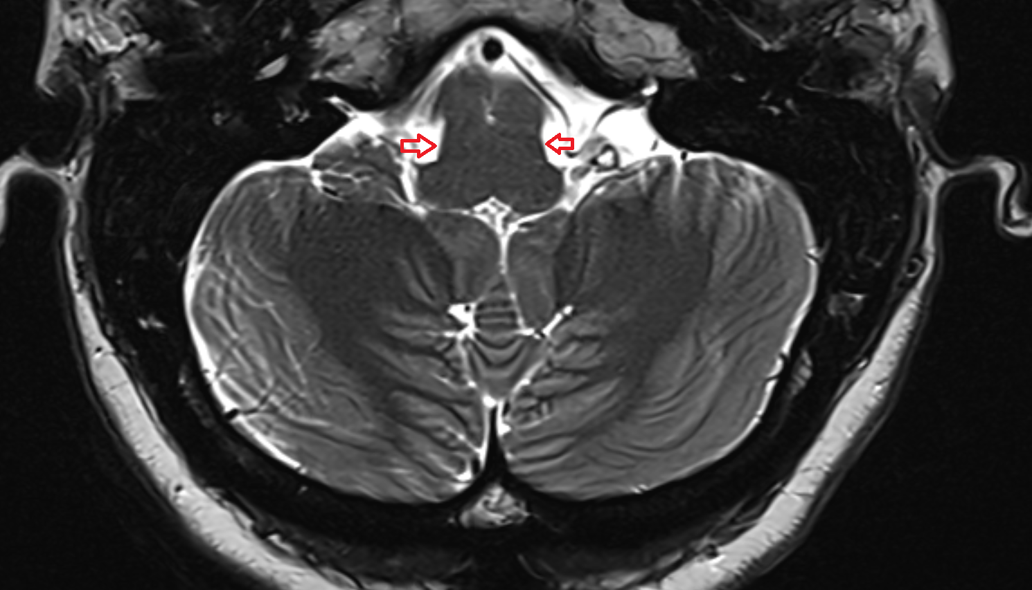 MRI Medullopontine sulcus axial anatomy image -img-00000-00000