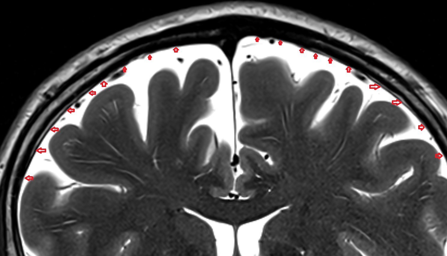 MRI Meninges coronal anatomy image -img-00000-00000