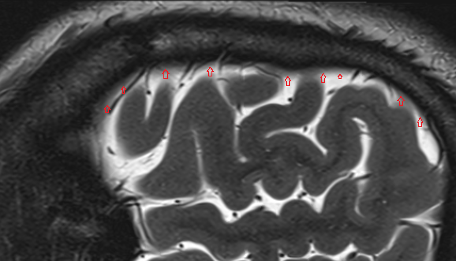 MRI Meninges sagittal anatomy image -img-00000-00000