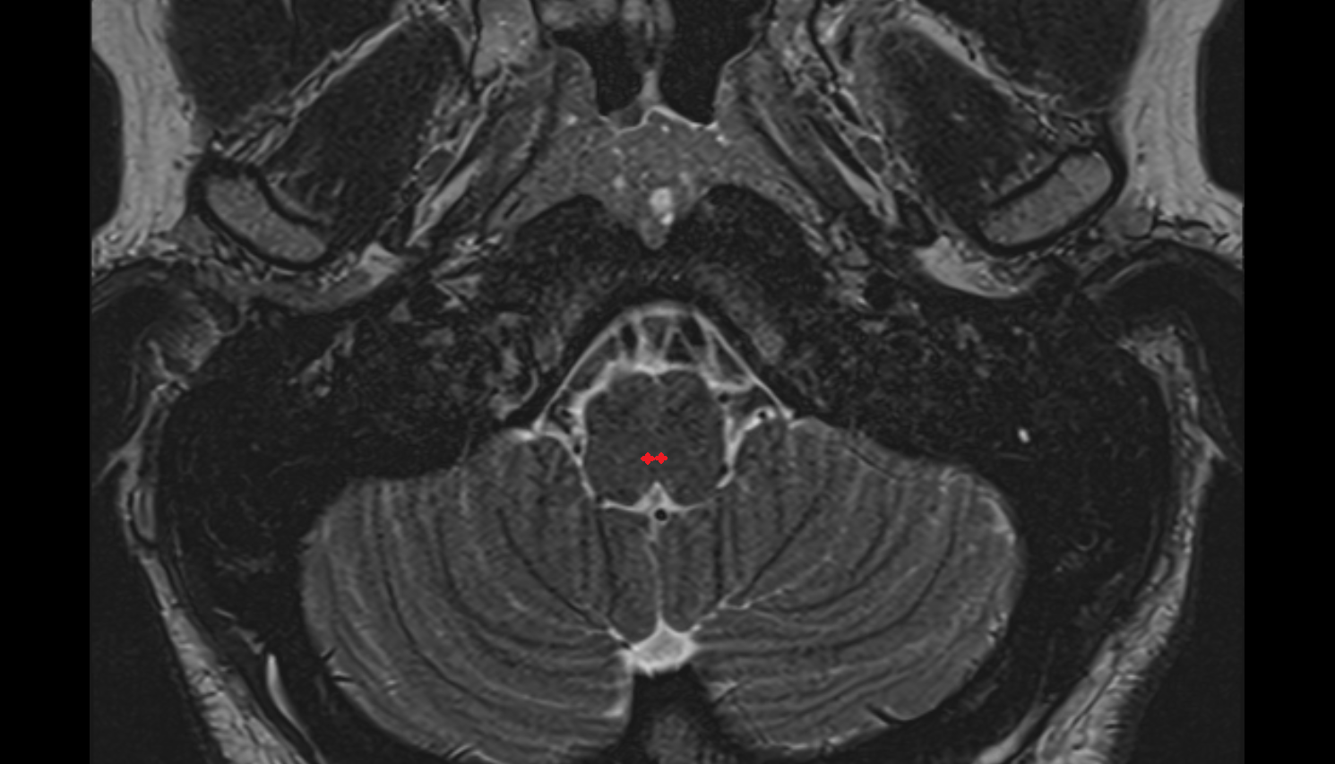 MRI Nucleus of the solitary tract  axial anatomy image -img-00000-00000