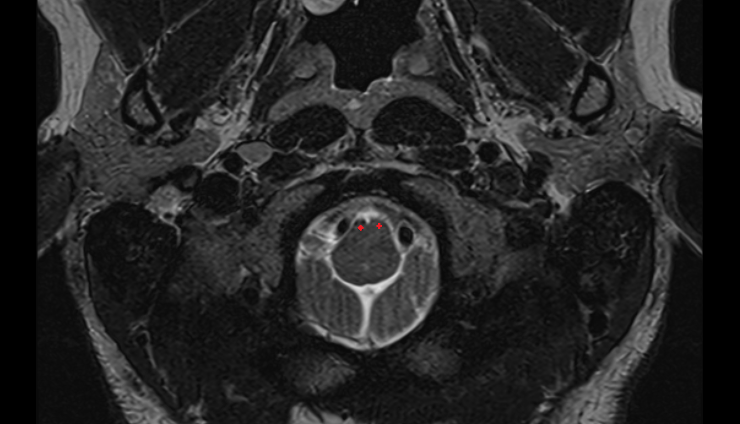 MRI Nucleus supraspinalis axial anatomy image -img-00000-00000