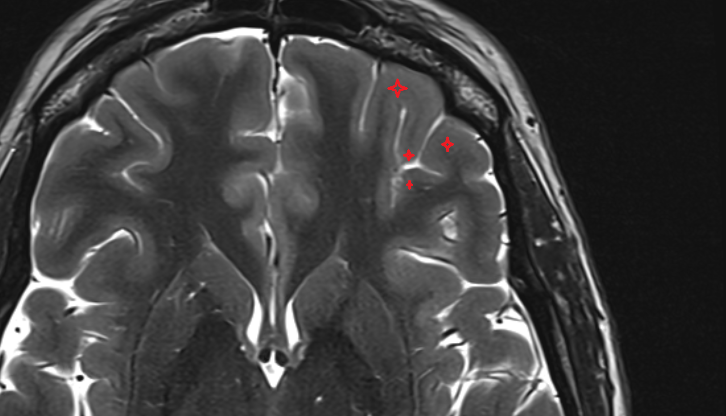 MRI Orbital gyri axial anatomy image -img-00000-00000