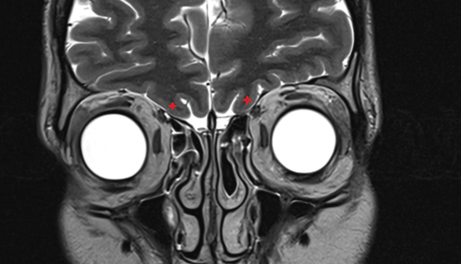 MRI Orbital gyri coronal anatomy image -img-00000-00000