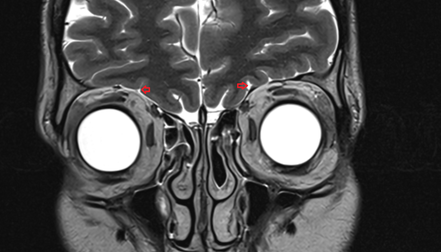 MRI Orbital sulci coronal anatomy image -img-00000-00000