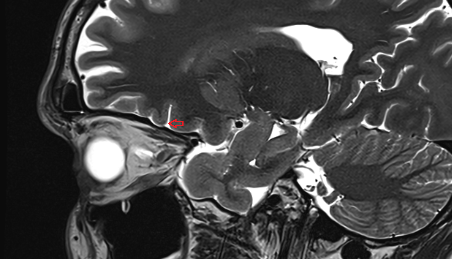 MRI Orbital sulci sag anatomy image -img-00000-00000