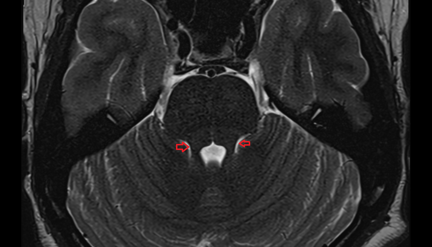 MRI Parabrachial recess axial anatomy image -img-00000-00000