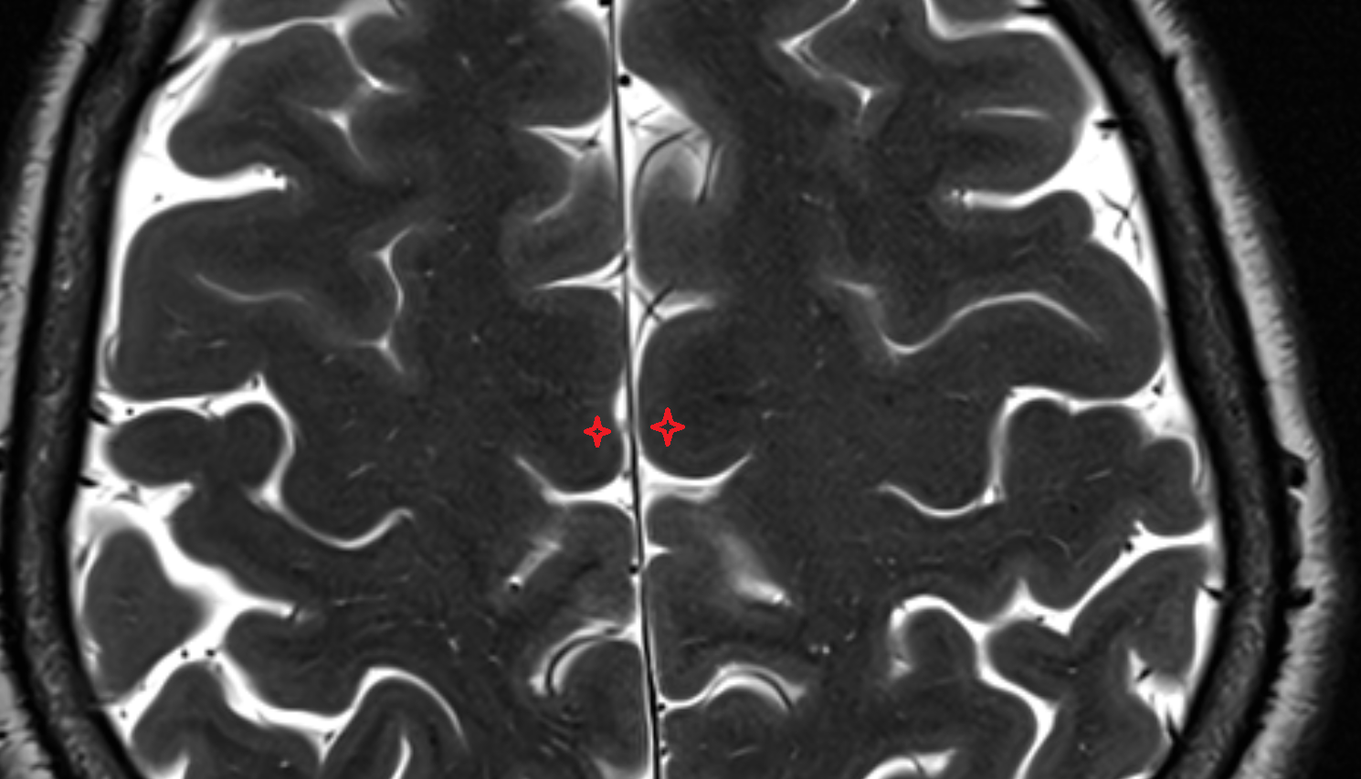 MRI Paracentral gyrus axial anatomy image -img-00000-00000