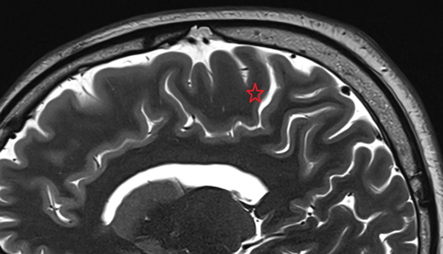 MRI Paracentral gyrus sagittal  anatomy image -img-00000-00000