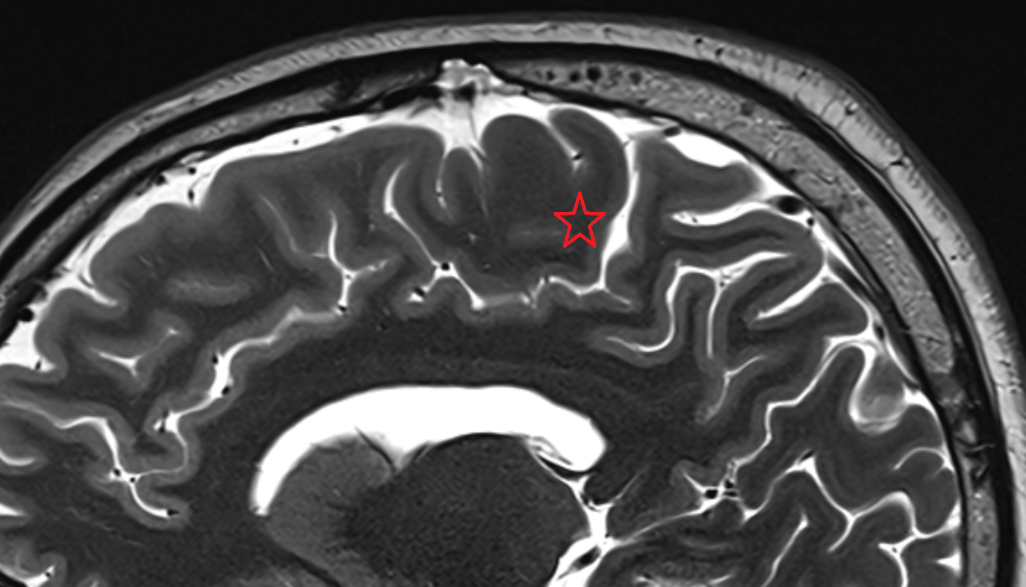 MRI Paracentral gyrus sagittal  anatomy image -img-00000-00000_00001
