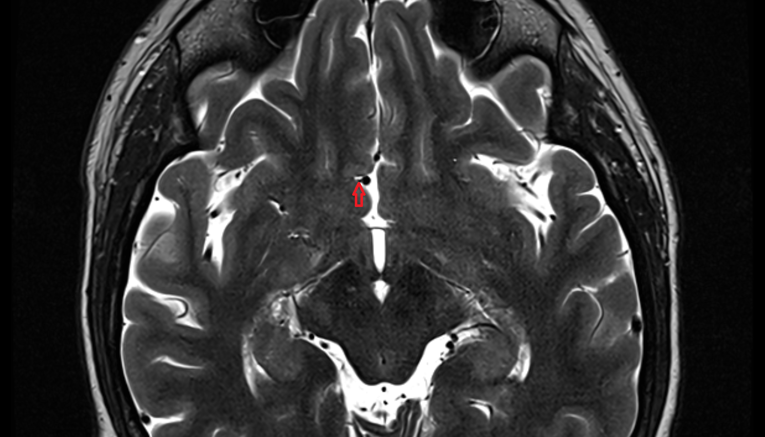 MRI Paraolfactory sulci axial anatomy image -img-00000-00000