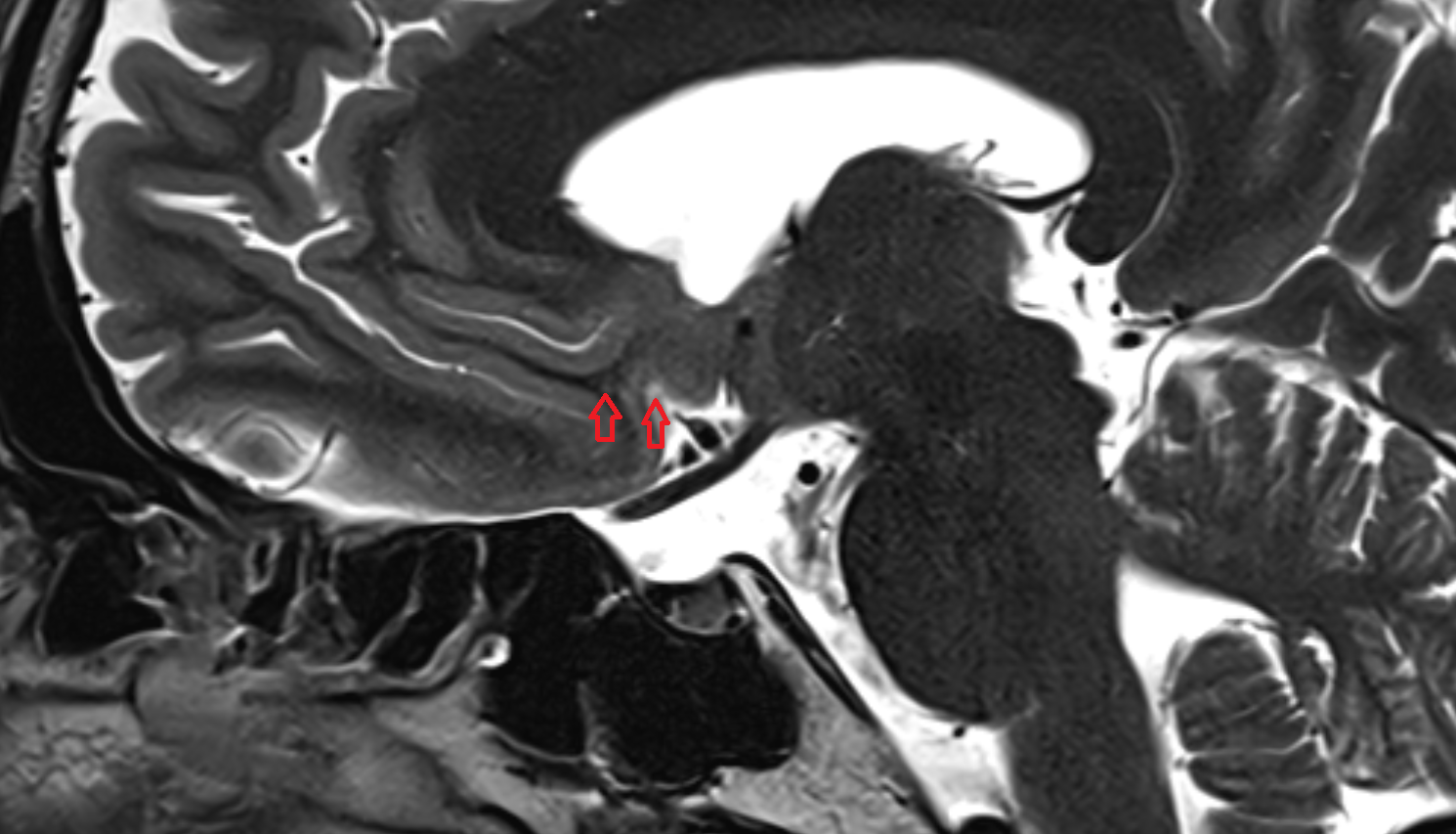 MRI Paraolfactory sulci sag anatomy image -img-00000-00000