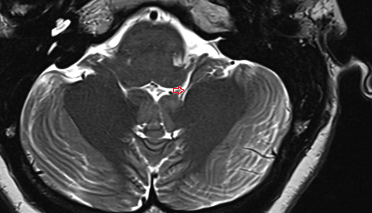 MRI  Peduncle of flocculus axial anatomy image -img-00000-00000