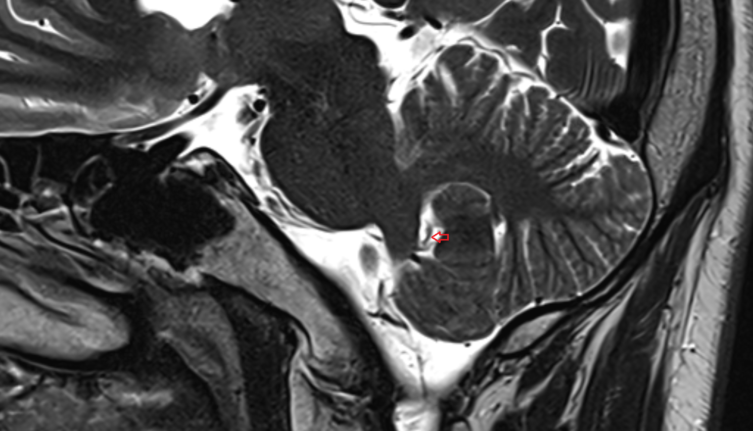 MRI  Peduncle of flocculus sag anatomy image -img-00000-00000