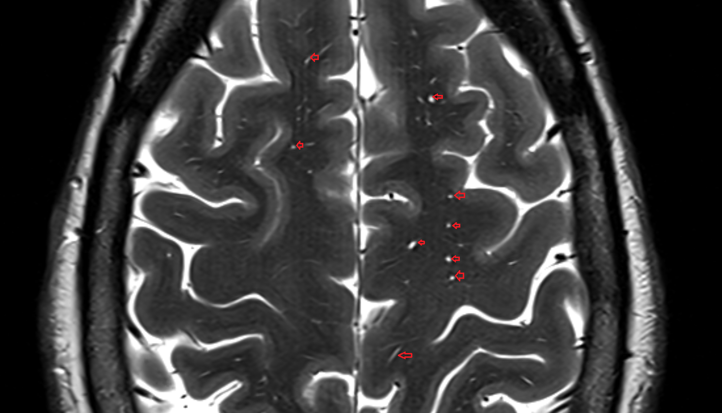 MRI Perivascular spaces (Virchow–Robin spaces) axial  anatomy image -img-00000-00000
