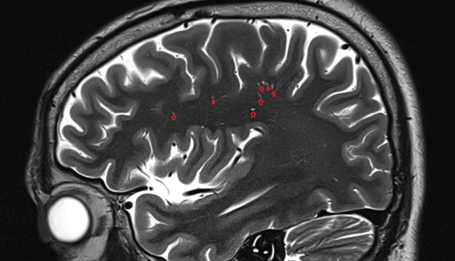 MRI Perivascular spaces (Virchow–Robin spaces) sagittal  anatomy image -img-00000-00000