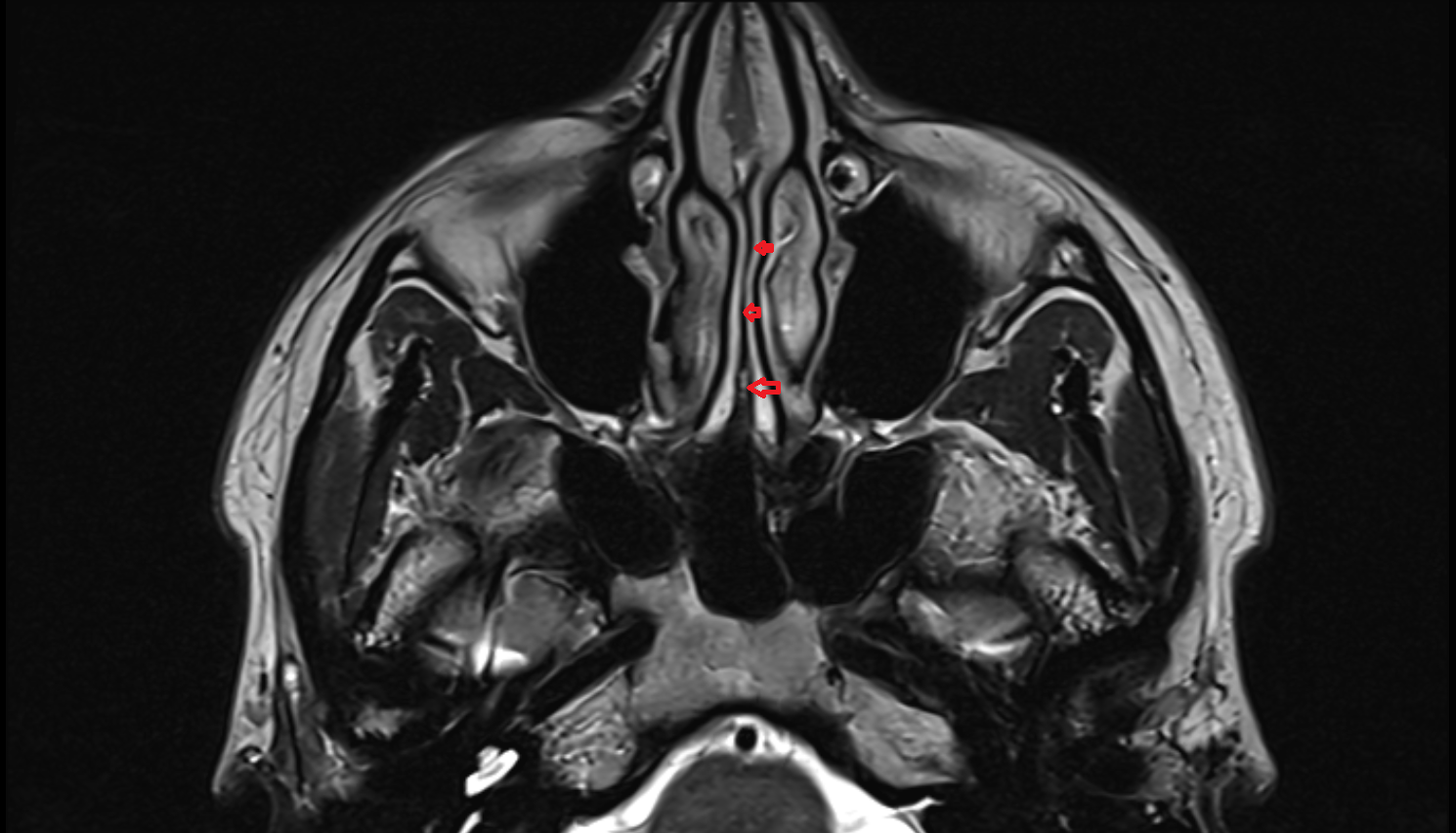 MRI Perpendicular plate  anatomy image -img-00000-00000