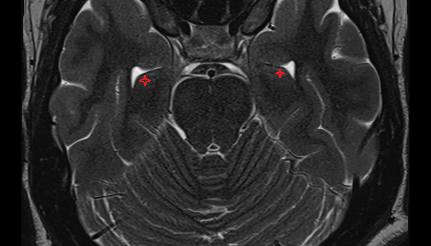 MRI Pes hippocampi axial anatomy image -img-00000-00000