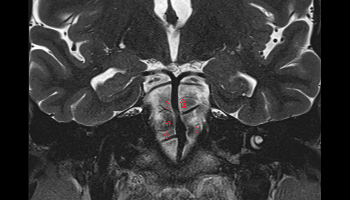 MRI Pontine arteries coronal anatomy image