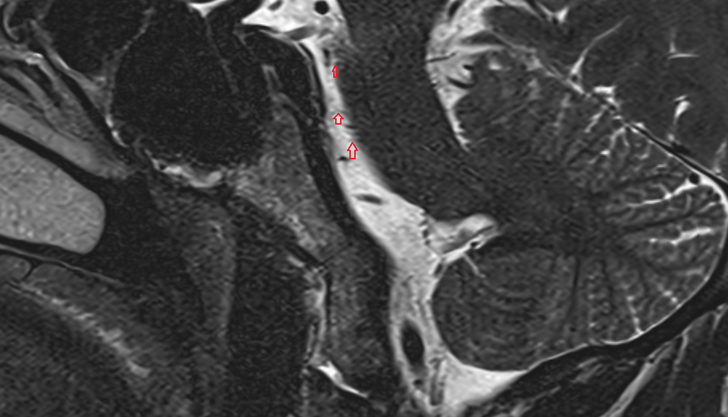 MRI Pontine arteries sag anatomy image