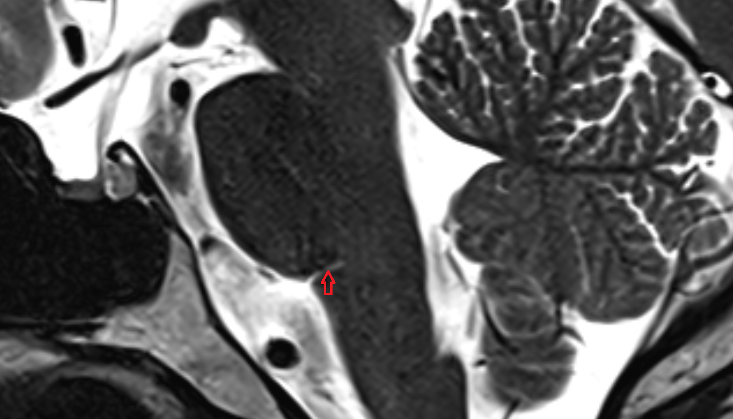 MRI Pontomedullary junction SAGITTAL anatomy image -img-00000-00000