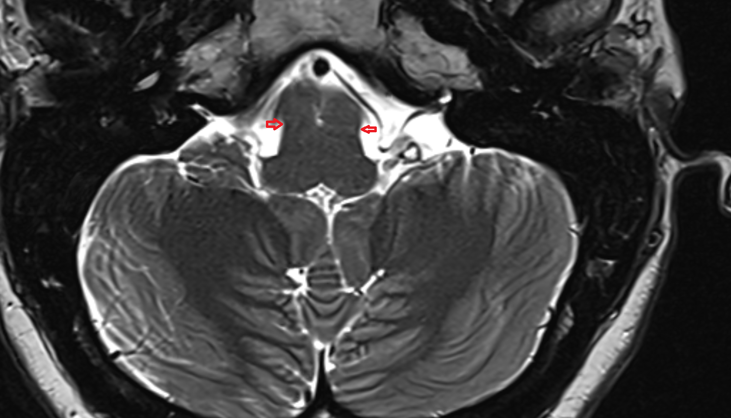 MRI Pontomedullary junction  axial anatomy image -img-00000-00000