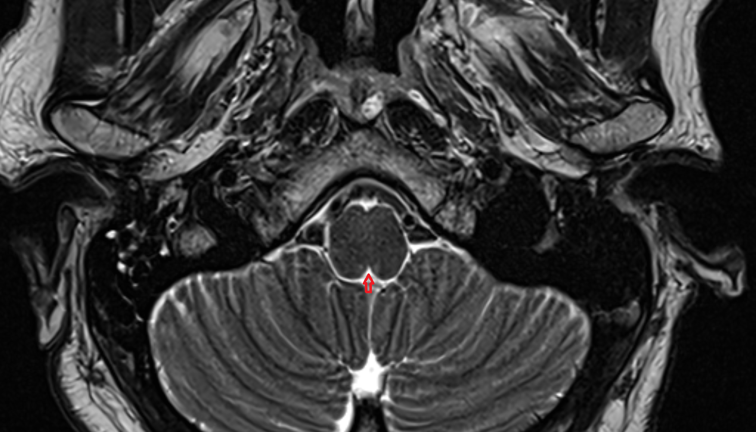 MRI Posterior median sulcus of medulla oblongata axial anatomy image -img-00000-00000