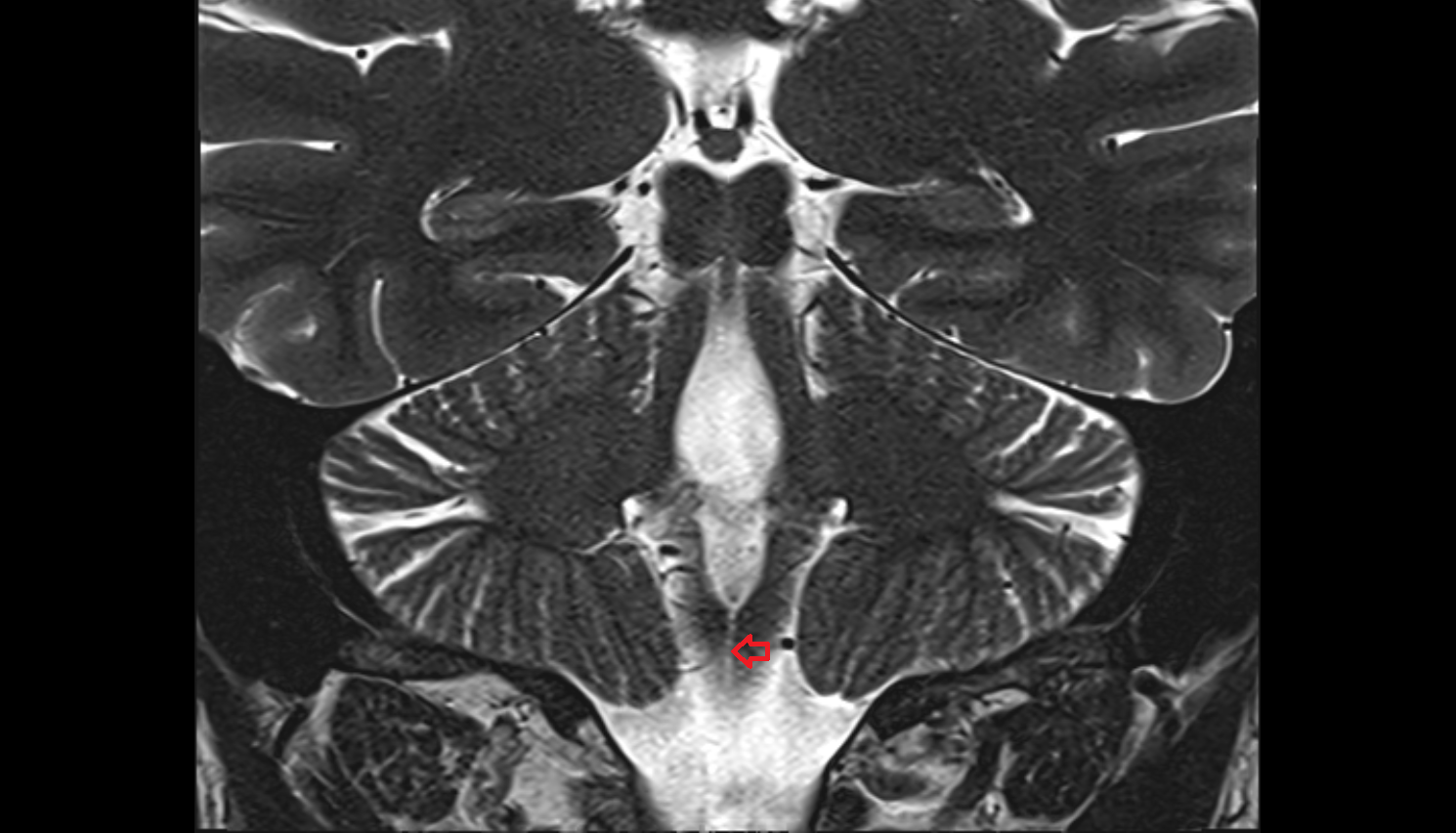 MRI Posterior median sulcus of medulla oblongata coronal anatomy image -img-00000-00000