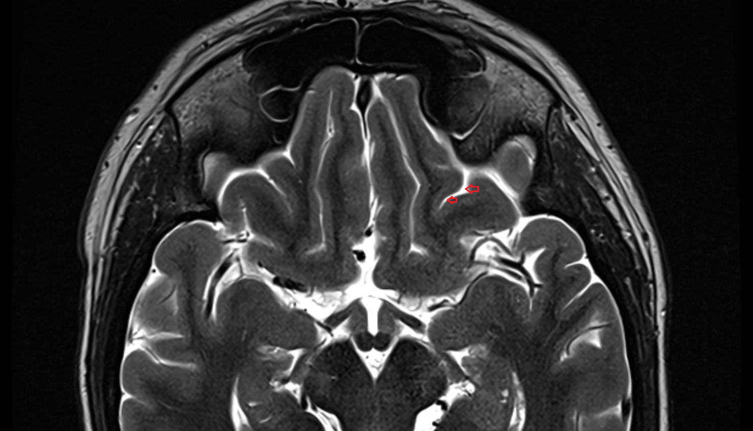 MRI Posterior orbital sulcus axial anatomy image -img-00000-00000