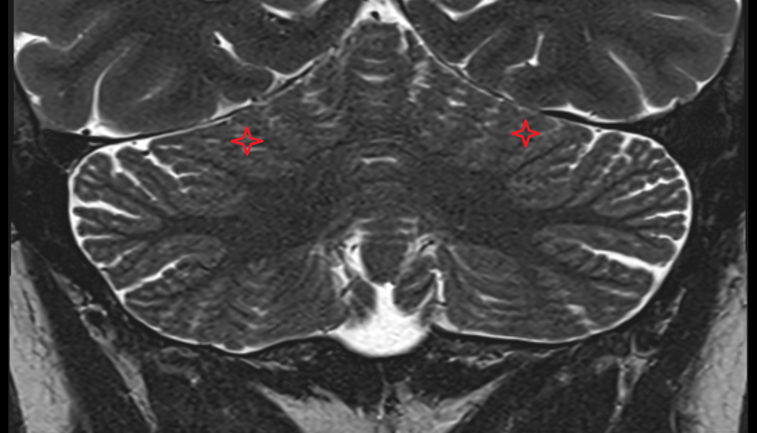 MRI  Posterior quadrangular lobule coronal anatomy image -img-00000-00000
