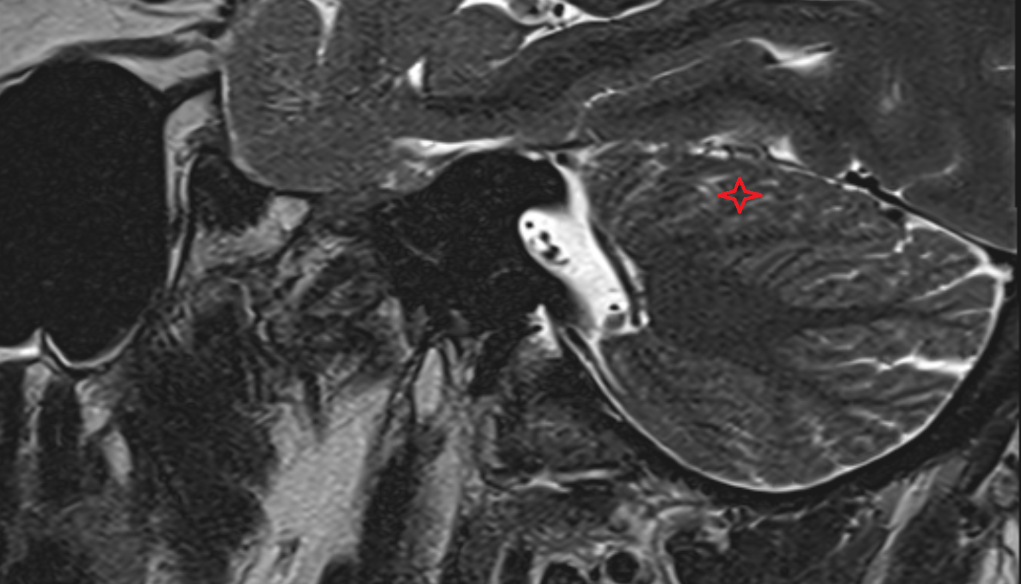 MRI  Posterior quadrangular lobule sag anatomy image -img-00000-00000