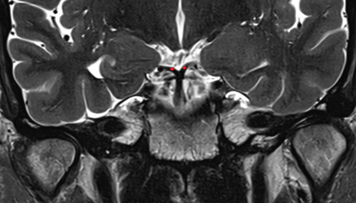 MRI Precommunicating part of posterior cerebral artery anatomy image -img-00000-00000