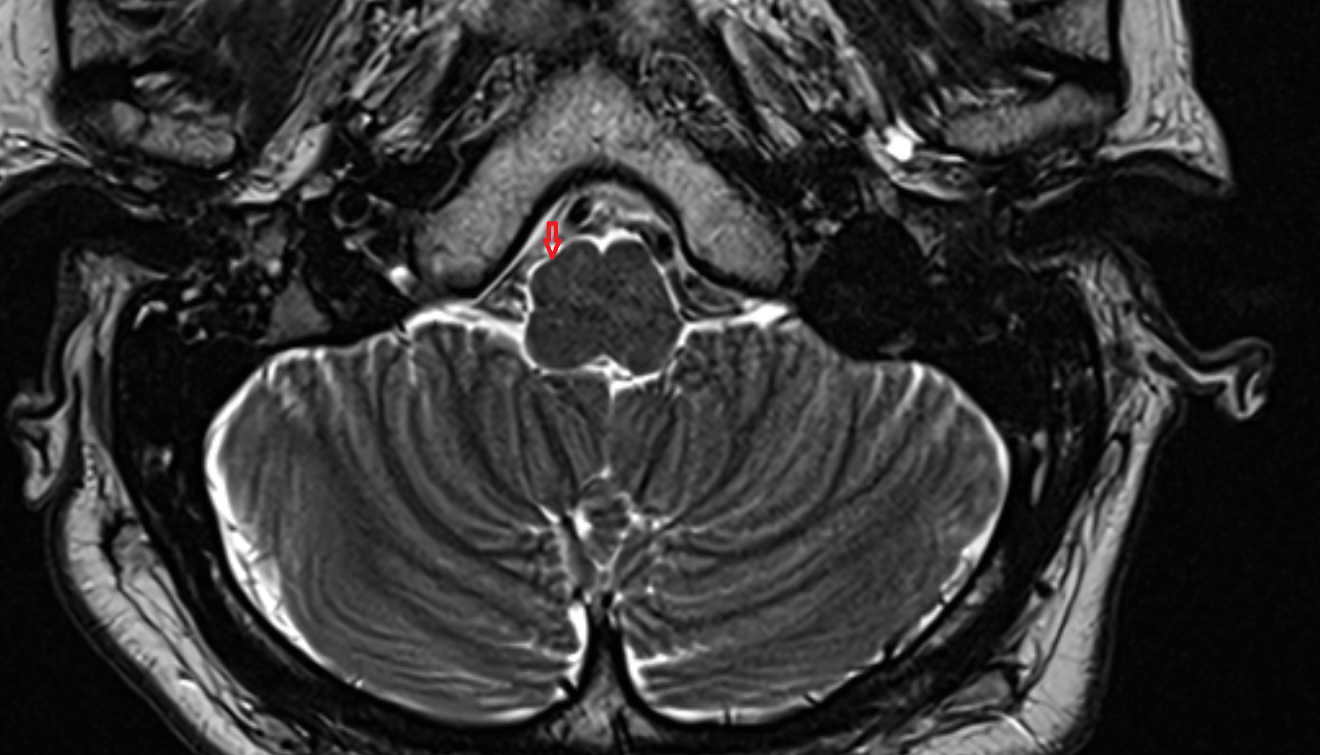 MRI Preolivary groove axial anatomy image -img-00000-00000