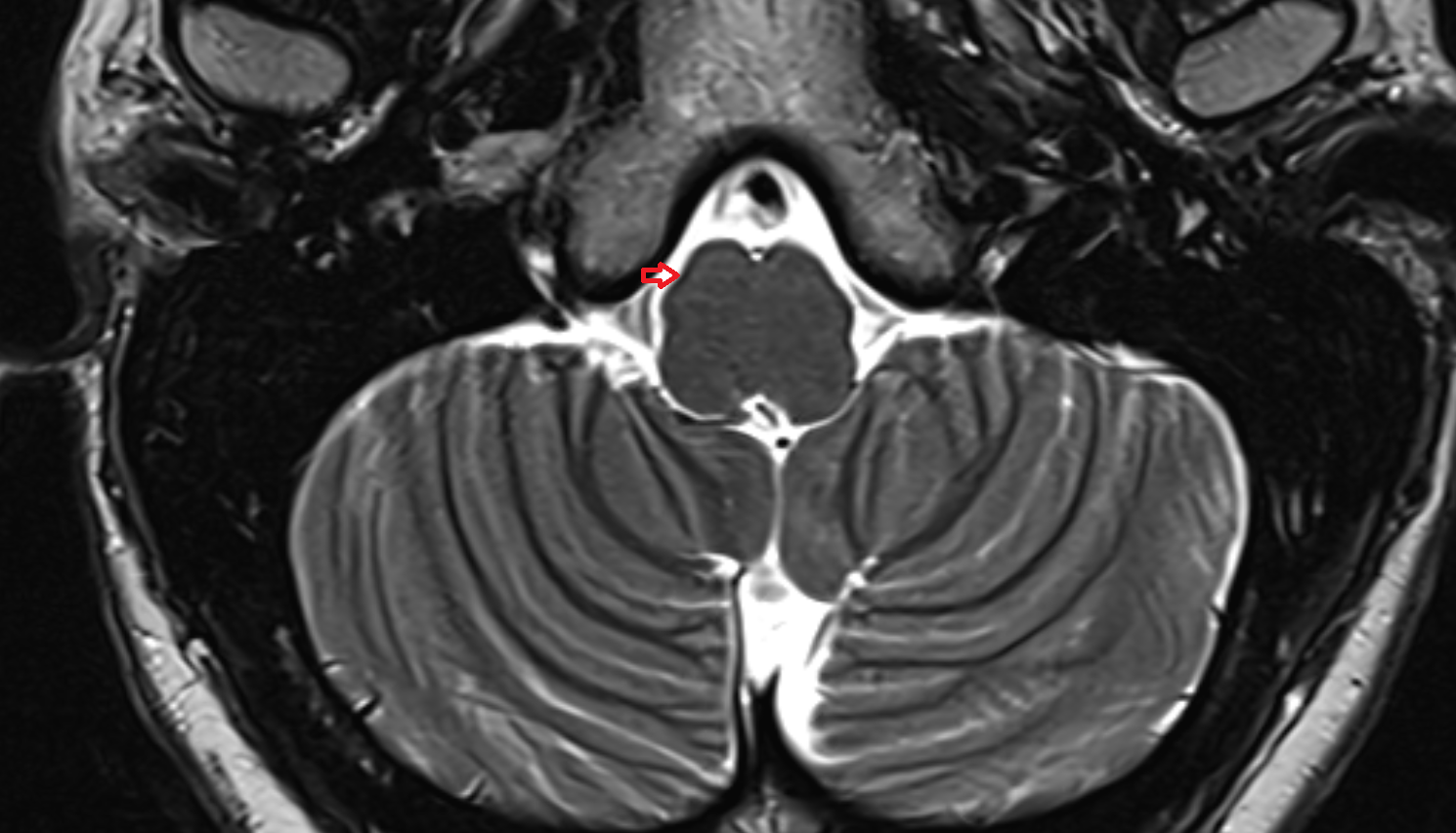 MRI Preolivary groove axial anatomy image -img-00000-00000_00001