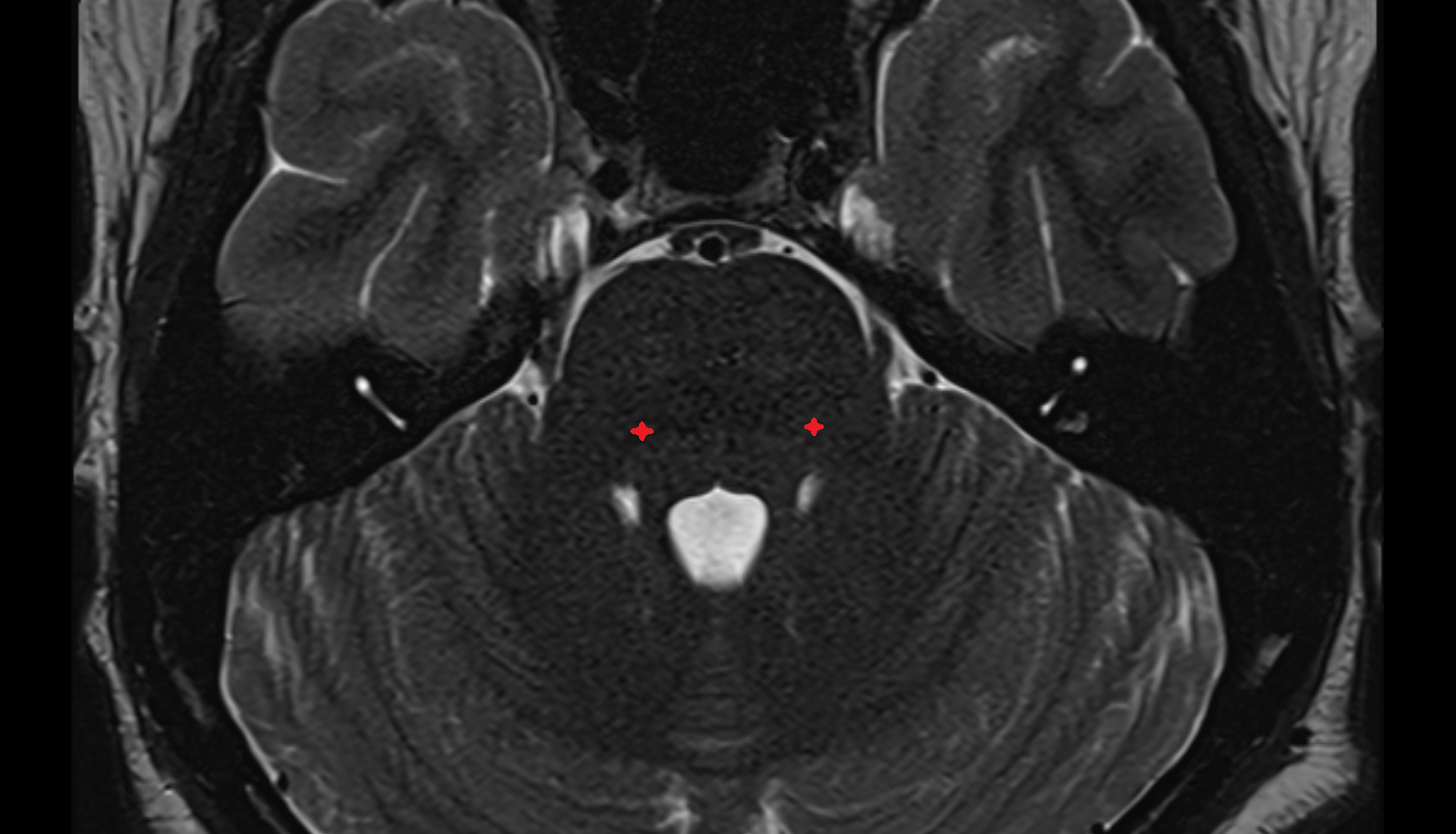 MRI Principal sensory nucleus of trigeminal nerve axial anatomy image -img-00000-00000