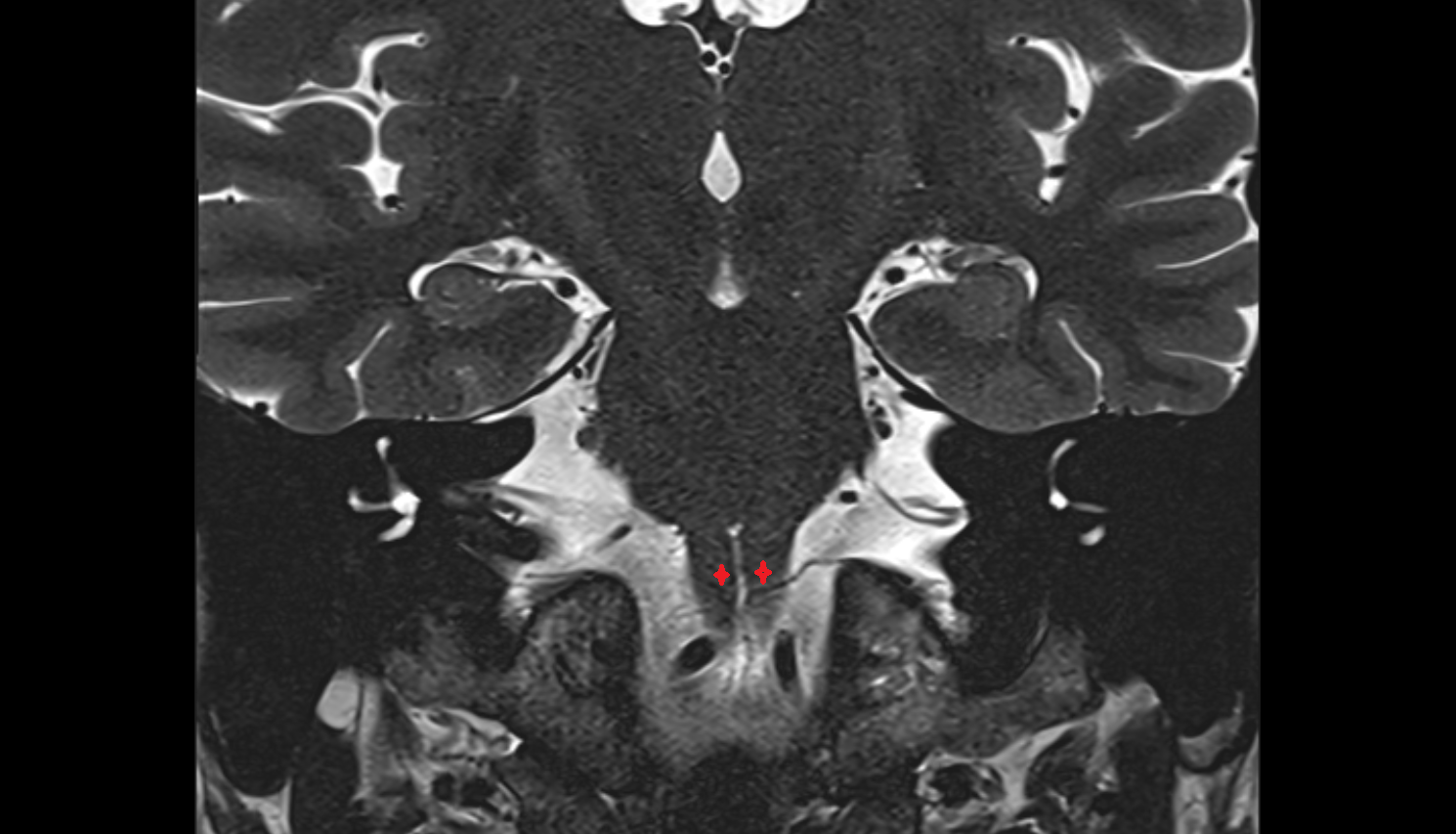 MRI Pyramid of medulla oblongata coronal anatomy image -img-00000-00000