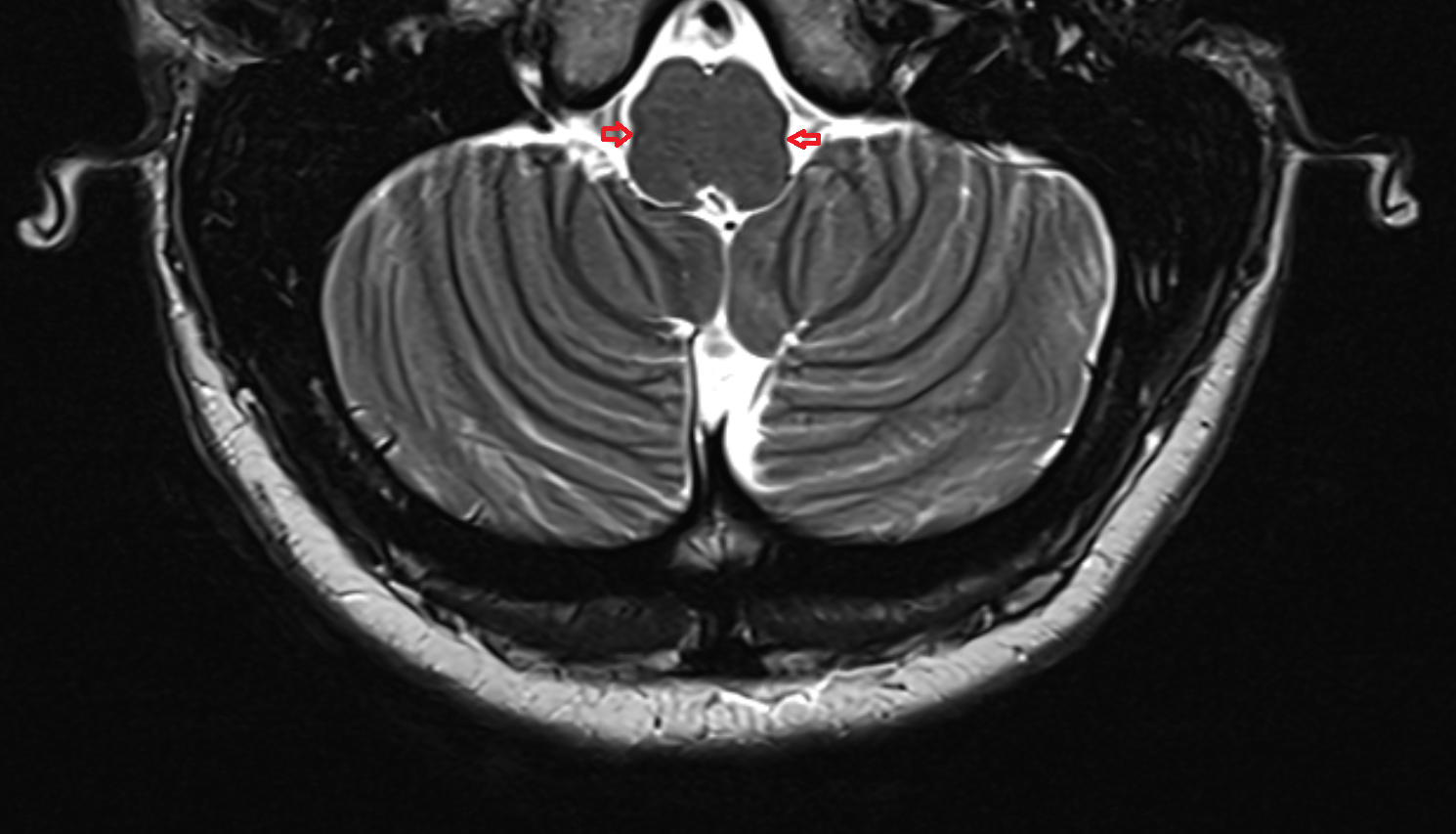 MRI Retroolivary groove axial anatomy image -img-00000-00000