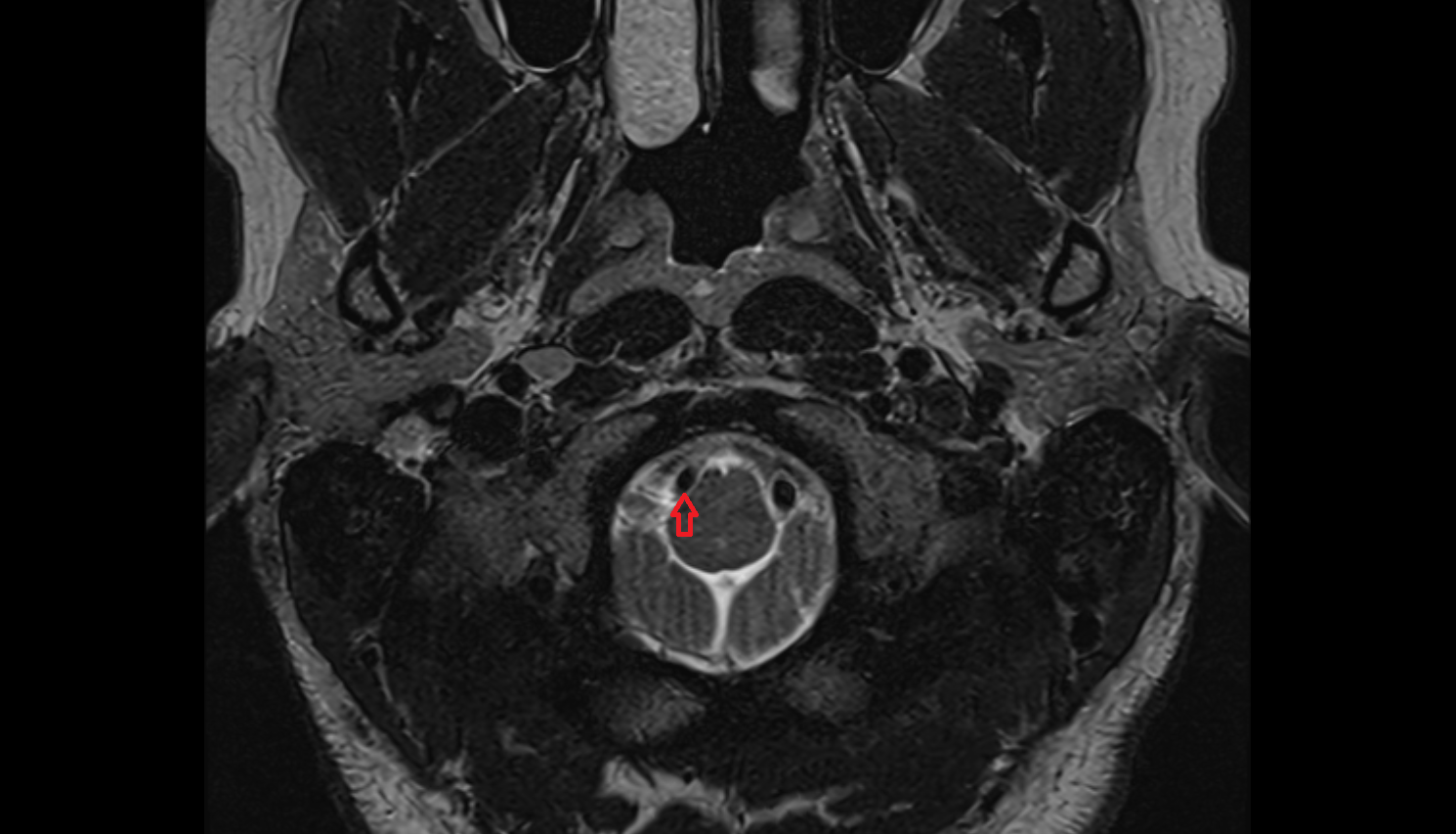 MRI Right vertebral artery axial anatomy image -img-00000-00000