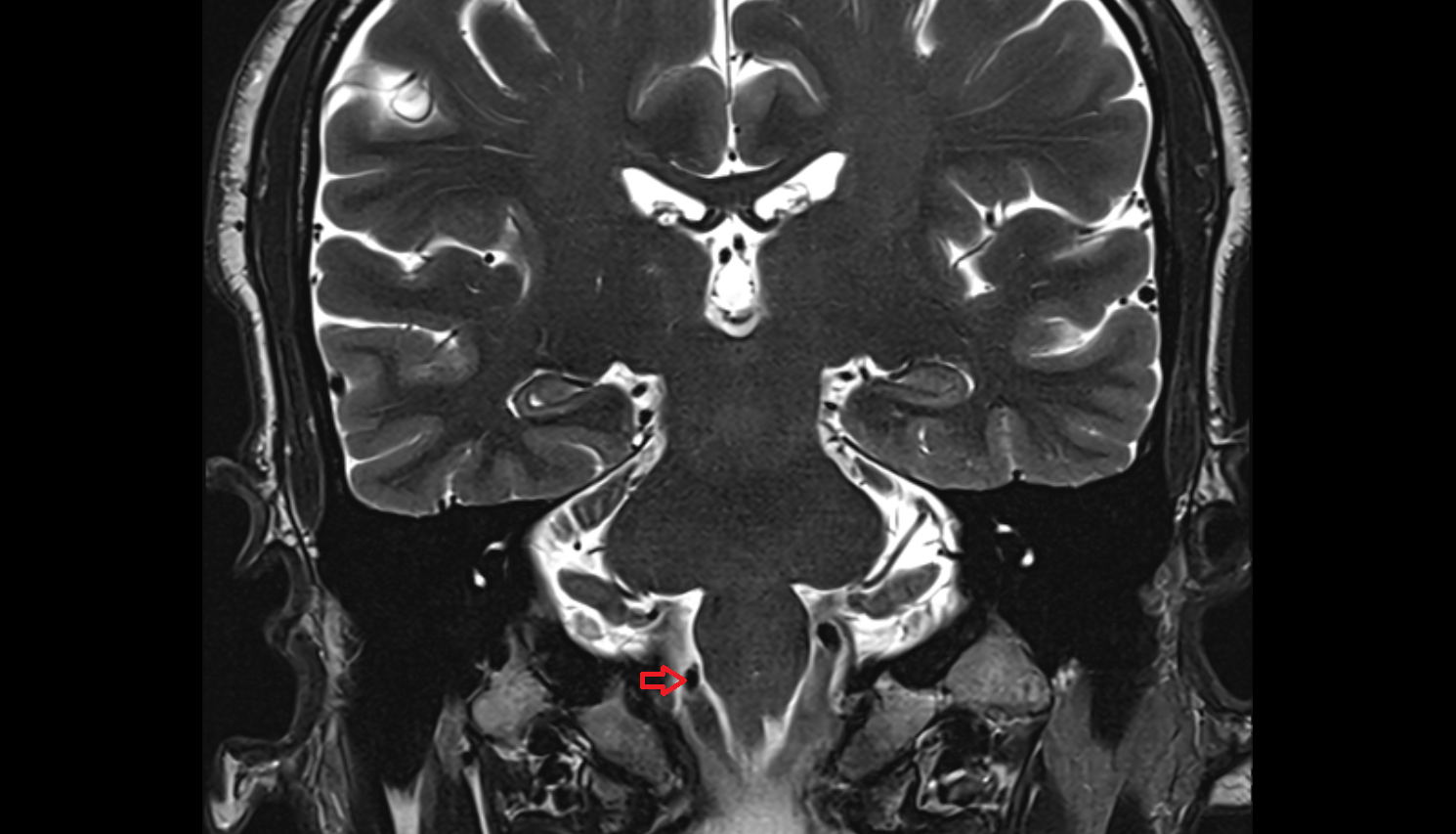 MRI Right vertebral artery coronal anatomy image -img-00000-00000