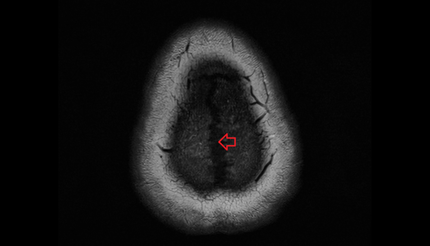 MRI Sagittal suture axial anatomy image -img-00000-00000